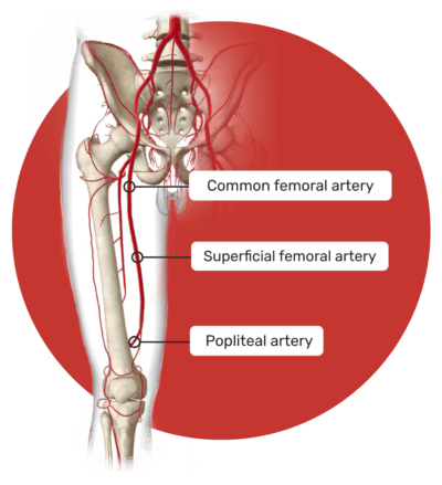 Flex Vessel Prep - Venture Med Group